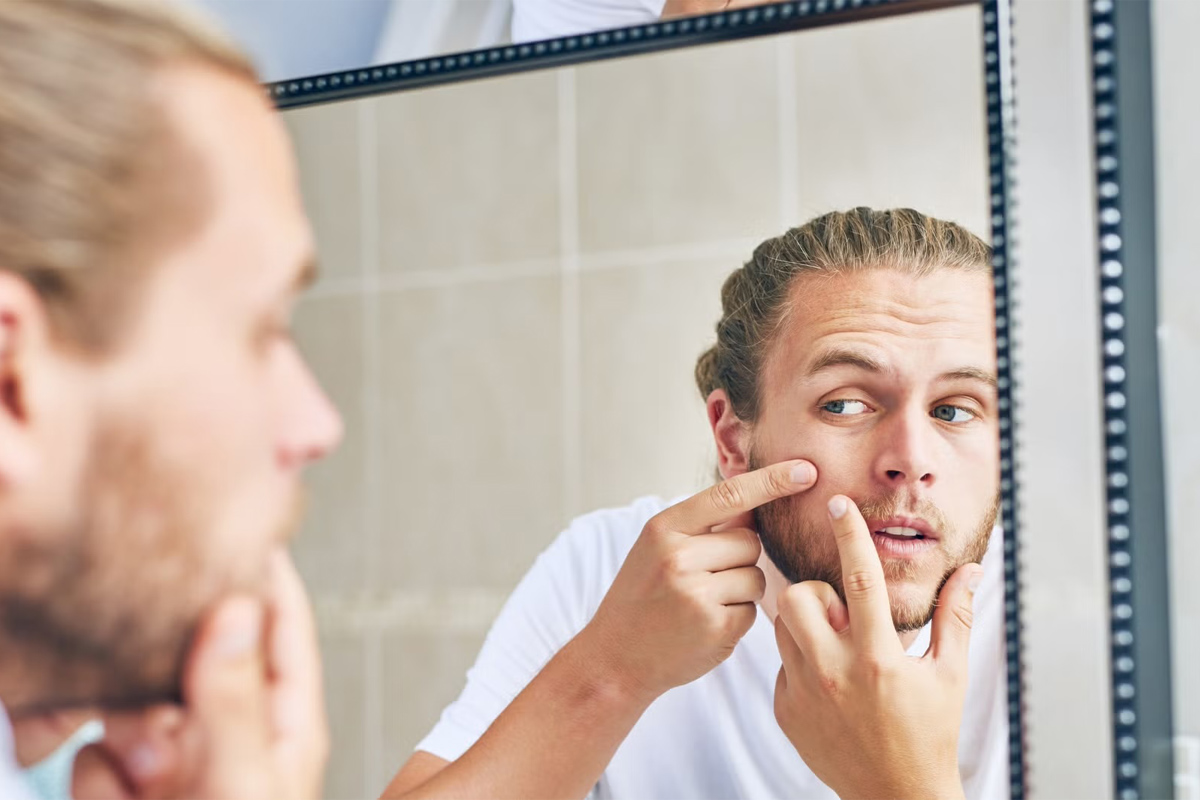 relación del sudor con el acné