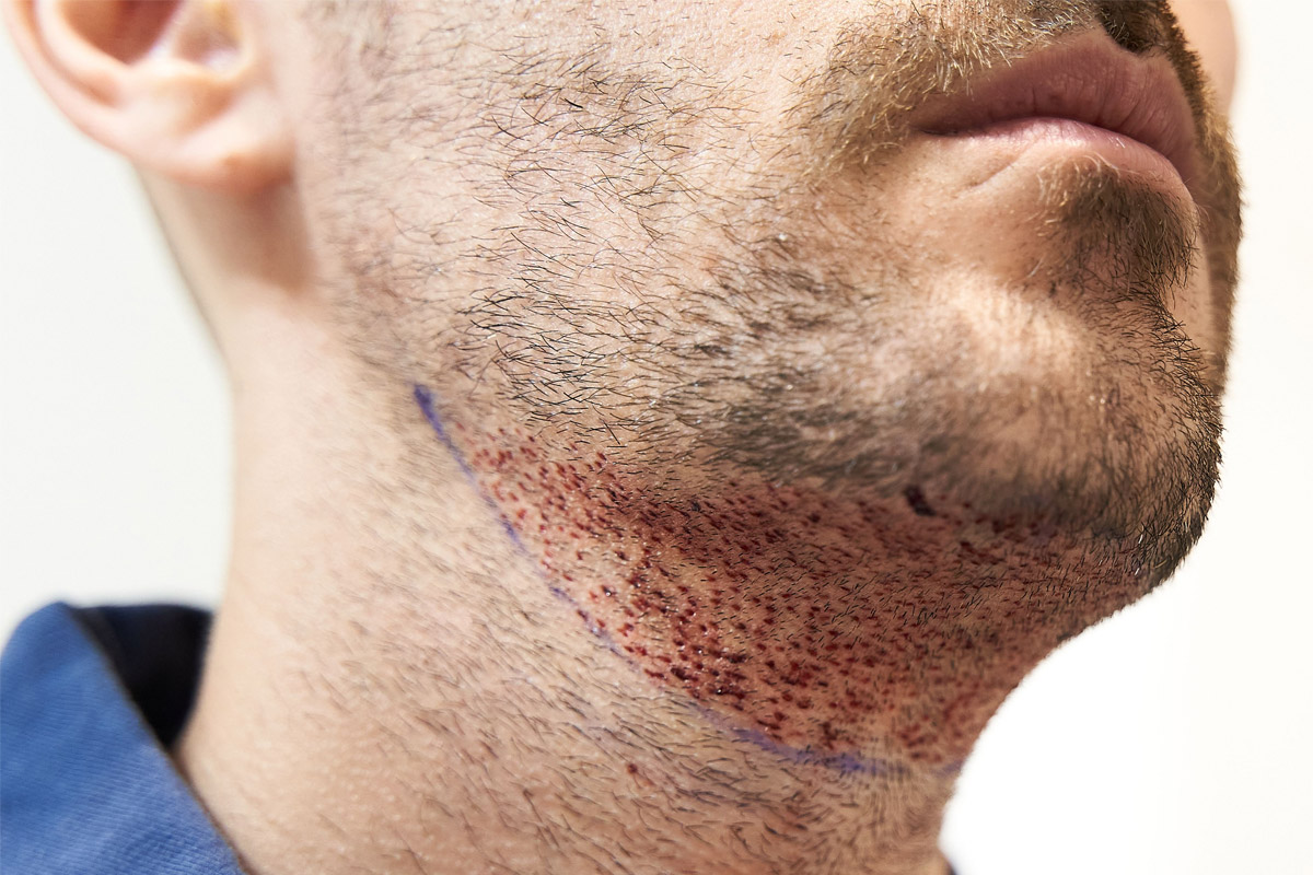 hombre después de un transplante de barba